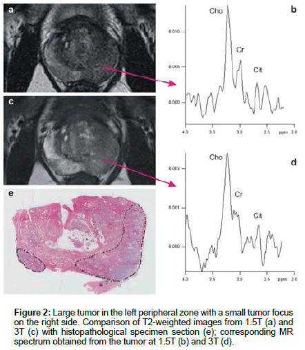diagnostic-techniques-Large-tumor