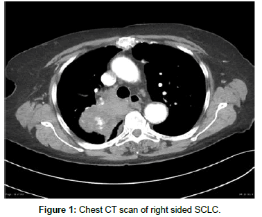 experimental-oncology-Chest-CT