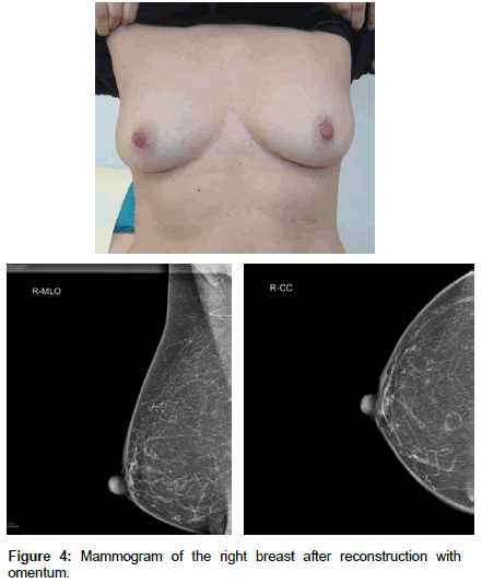 experimental-oncology-Mammogram