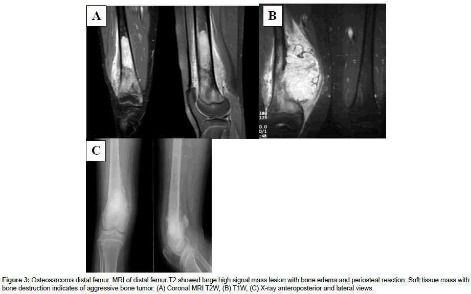 experimental-oncology-Osteosarcoma