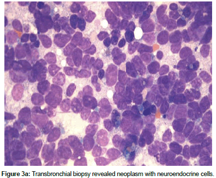 experimental-oncology-Transbronchial