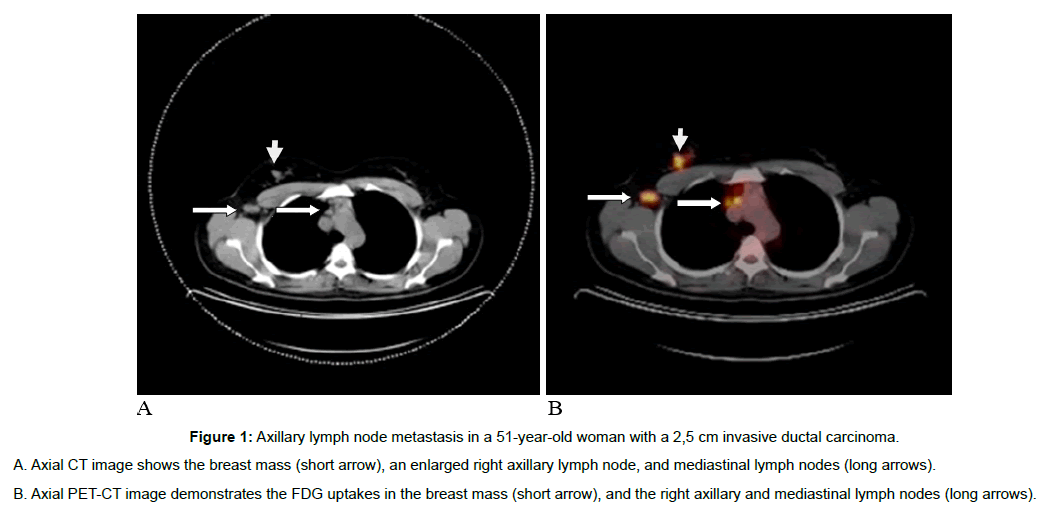 experimental-oncology-invasive-ductal-carcinoma