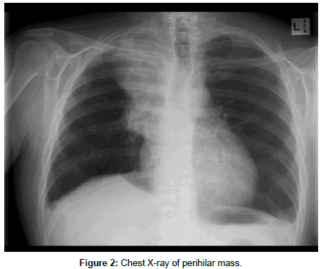 experimental-oncology-perihilar-mass