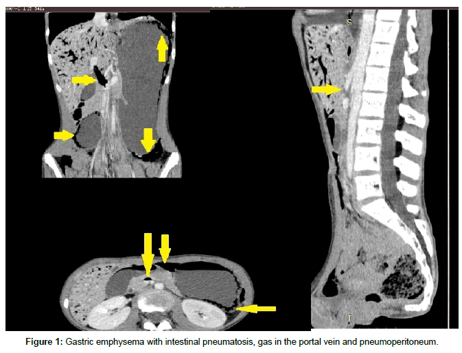 food-nutritional-disorders-Gastric-emphysema