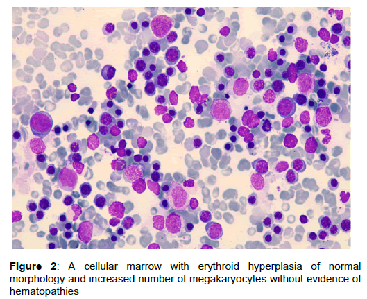 gastroenterology-erythroid-hyperplasia