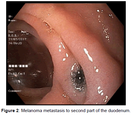 gastroenterology-melanoma-metastasis