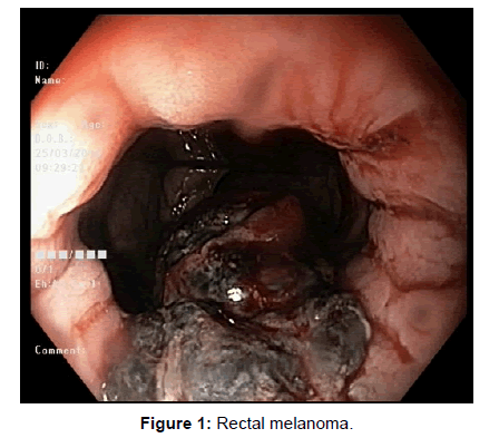 gastroenterology-rectal-melanoma