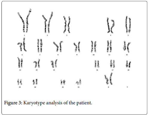genetic-disorders-Karyotype-analysis