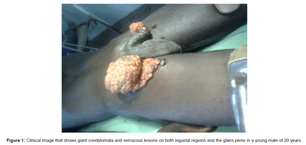 Condilomatoza genitală - Viața Medicală Condilom gigant bushke