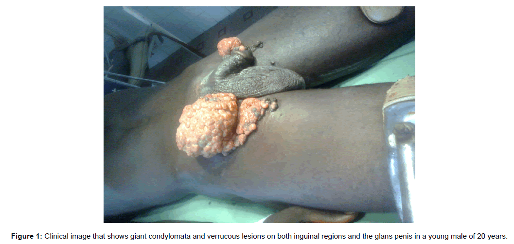 immune-therapies-verrucous-lesions