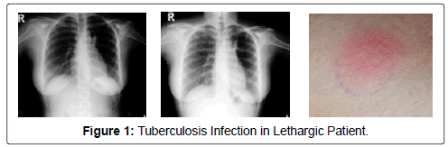 infectious-diseases-Tuberculosis-Infection