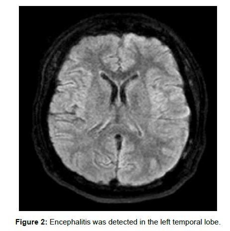 infectious-diseases-left-temporal-lobe