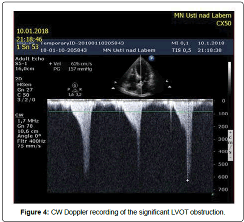 international-cardiovascular-LVOT-obstruction