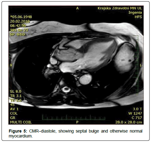 international-cardiovascular-LVOT-obstruction