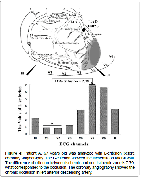 international-cardiovascular-ischemic-myocardium