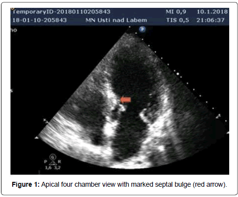 international-cardiovascular-septal-bulge