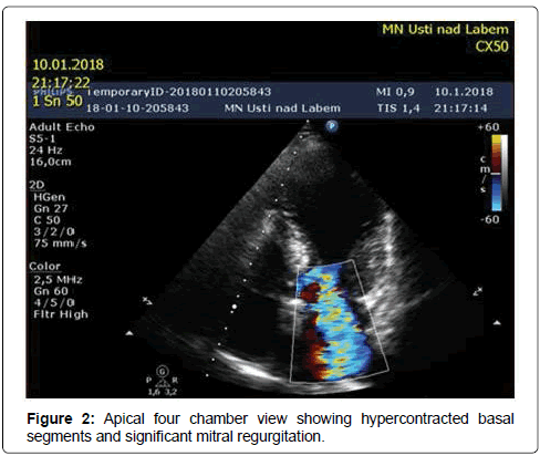 international-cardiovascular-septal-hypercontracted