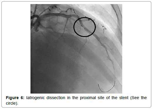 international-journal-of-cardiovascular-research-Iatrogenic-dissection