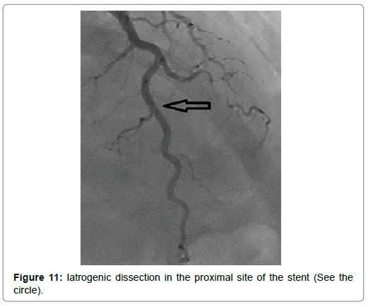 international-journal-of-cardiovascular-research-Iatrogenic-dissection