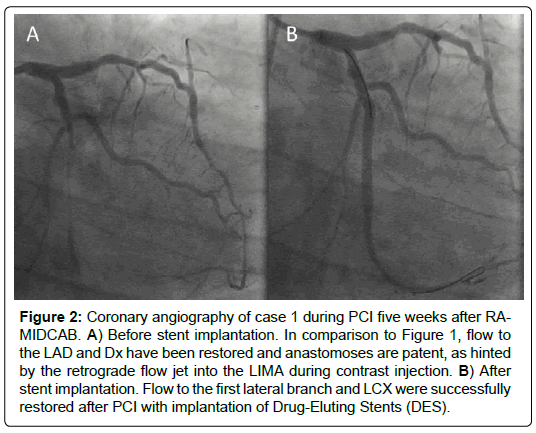 international-journal-of-cardiovascular-research-anastomoses