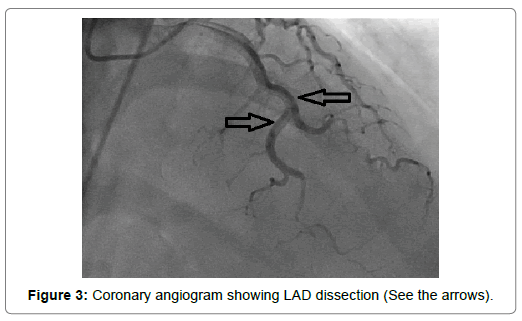 international-journal-of-cardiovascular-research-angiogram-showing