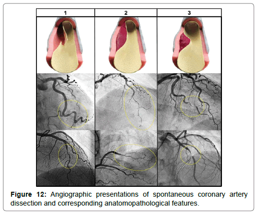 international-journal-of-cardiovascular-research-angiographic-presentations