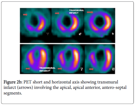 international-journal-of-cardiovascular-research-antero-septal