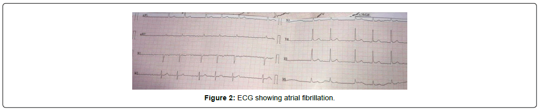 international-journal-of-cardiovascular-research-atrial-fibrillation
