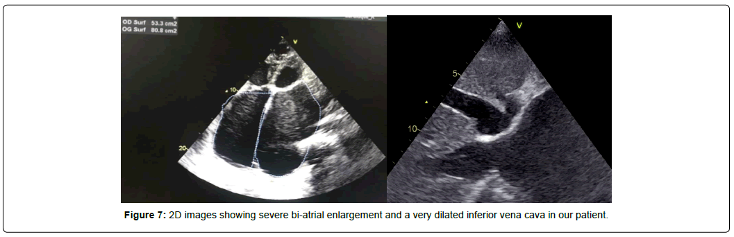 international-journal-of-cardiovascular-research-bi-atrial-enlargement