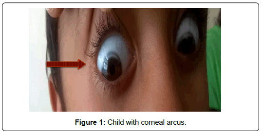 international-journal-of-cardiovascular-research-corneal-arcus
