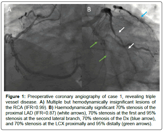 international-journal-of-cardiovascular-research-coronary-angiography