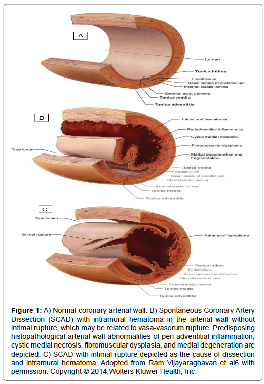 international-journal-of-cardiovascular-research-coronary-arterial