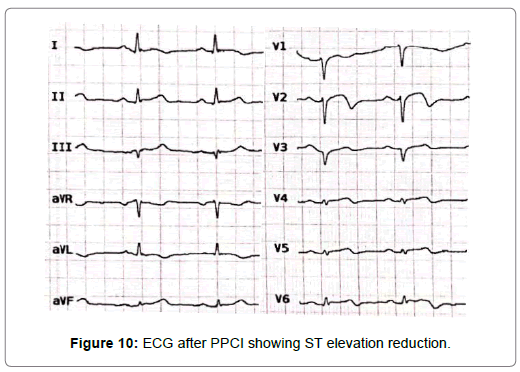 international-journal-of-cardiovascular-research-elevation-reduction