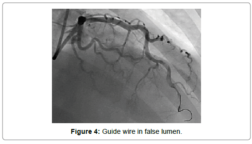 international-journal-of-cardiovascular-research-false-lumen