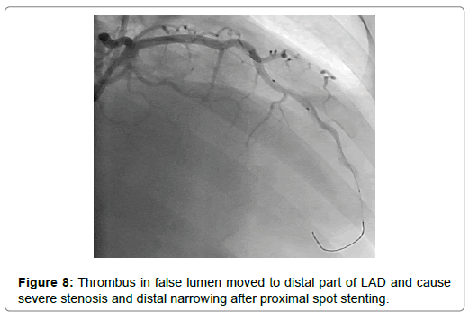 international-journal-of-cardiovascular-research-false-lumen