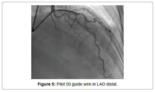 international-journal-of-cardiovascular-research-guide-wire