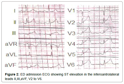 international-journal-of-cardiovascular-research-inferoantrolateral