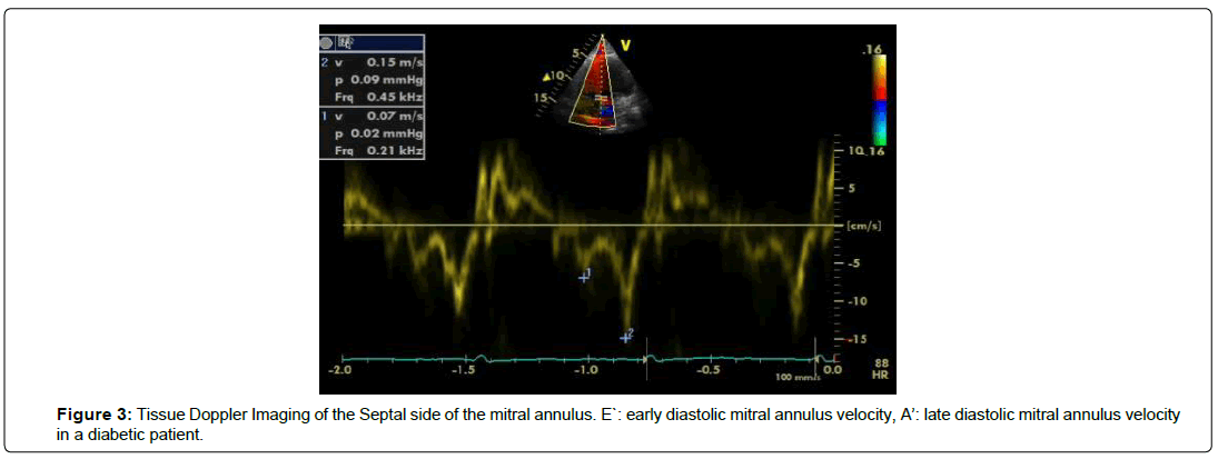 international-journal-of-cardiovascular-research-late-diastolic