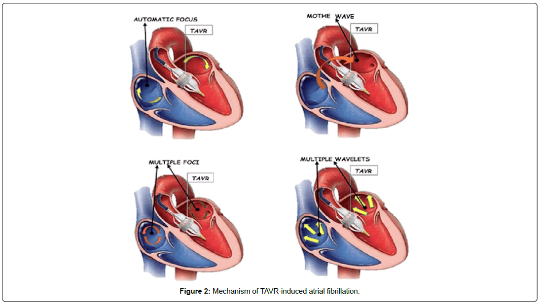 international-journal-of-cardiovascular-research-mechanism