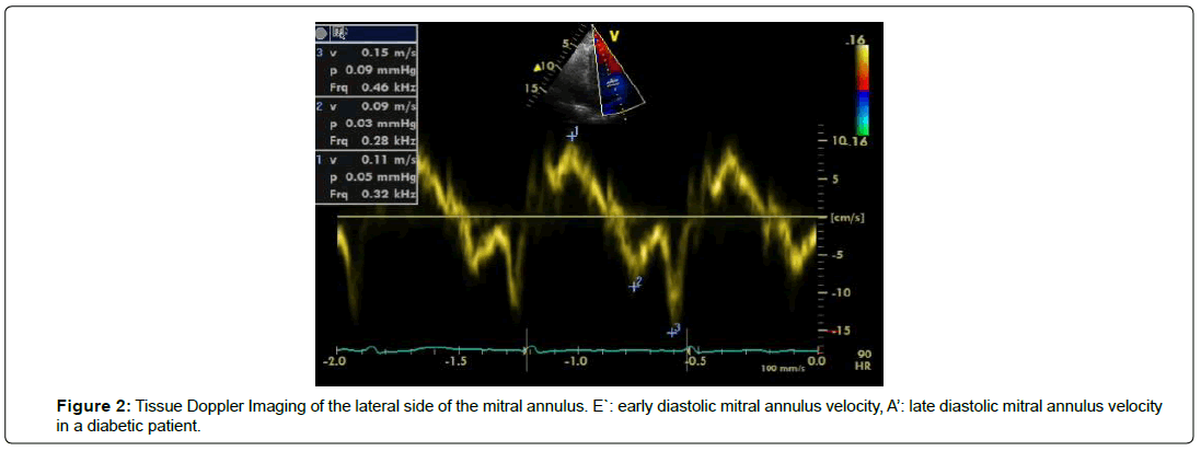 international-journal-of-cardiovascular-research-mitral-annulus