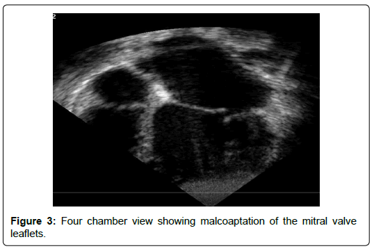 international-journal-of-cardiovascular-research-mitral-valve