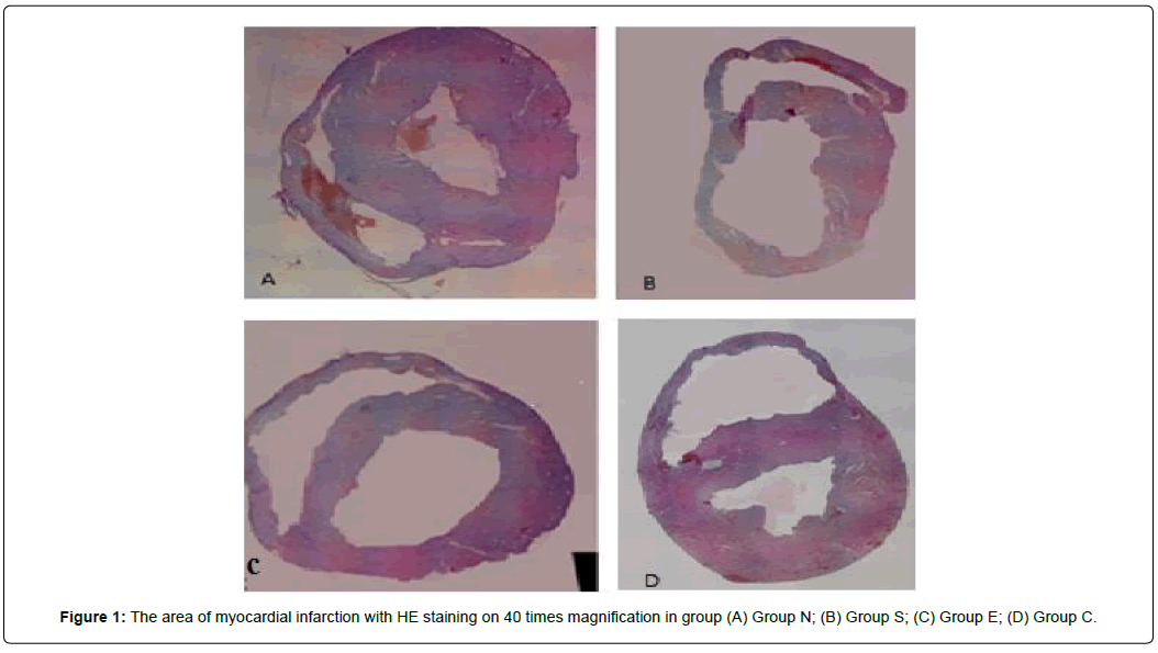 international-journal-of-cardiovascular-research-myocardial-infarction