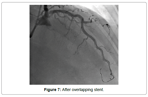 international-journal-of-cardiovascular-research-overlapping-stent