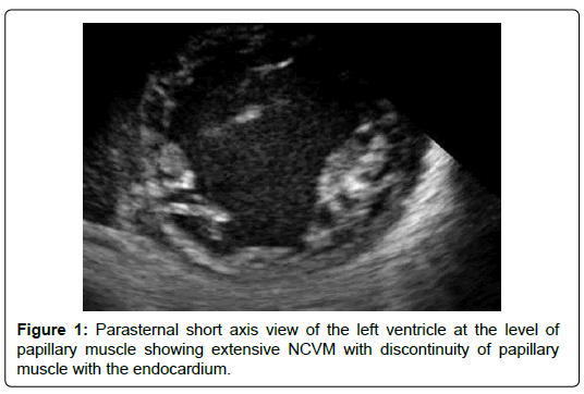 international-journal-of-cardiovascular-research-short-axis-view