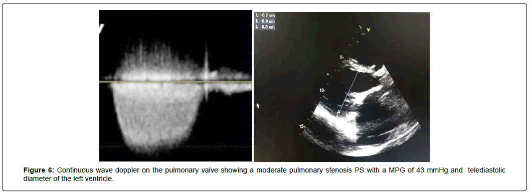 international-journal-of-cardiovascular-research-telediastolic-diameter