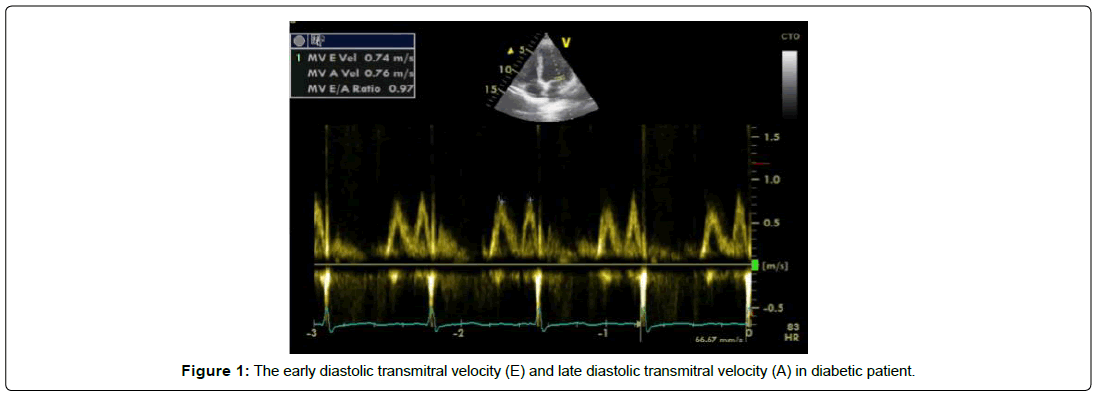 international-journal-of-cardiovascular-research-transmitral-velocity