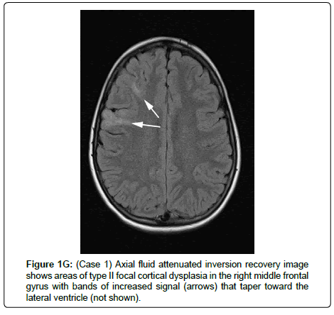 international-journal-ophthalmic-pathology-Axial-fluid