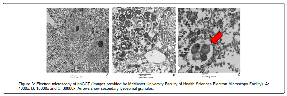 international-journal-ophthalmic-pathology-Electron-microscopy