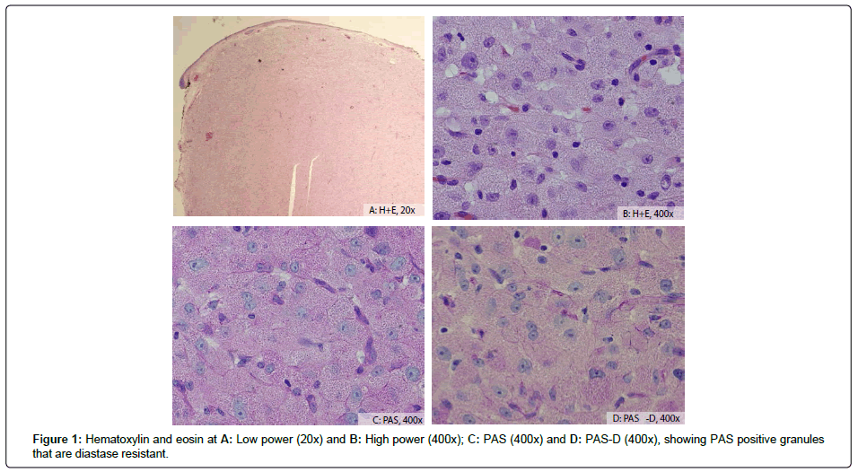 international-journal-ophthalmic-pathology-Hematoxylin-eosin