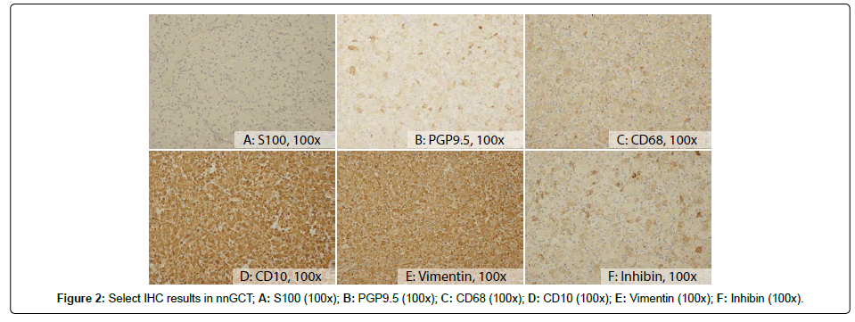 international-journal-ophthalmic-pathology-IHC-results